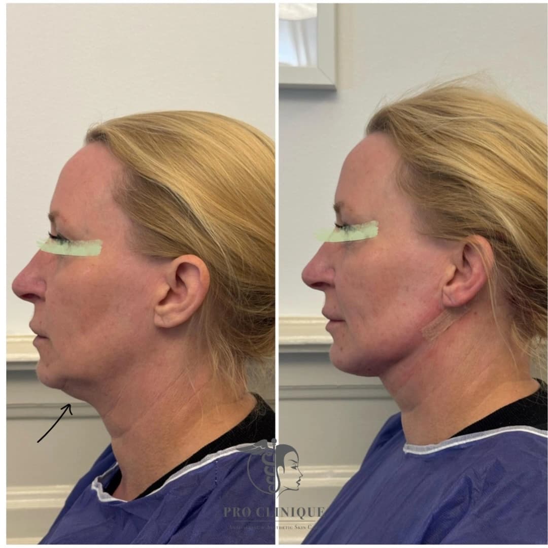 Resultat efter mini-fettsugning och halslyft